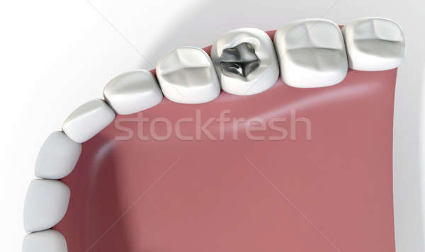 Teeth With Lead Filling Stock photo © albund