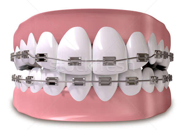 Teeth Fitted With Braces Close Stock photo © albund