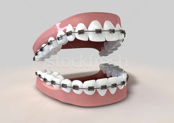 Stock photo: Teeth Fitted With Braces