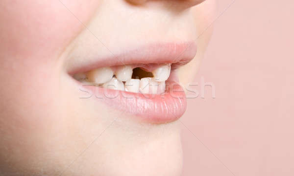 Perdu dents heureux fond bouche Kid [[stock_photo]] © All32