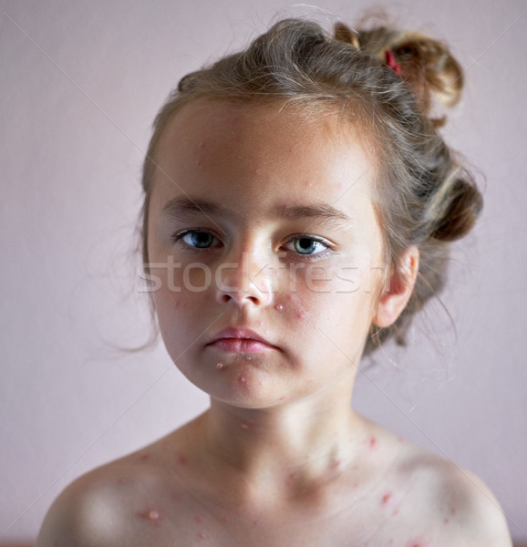 Portrait of a lovely 6 years old little girl with chickenpox  Stock photo © amok