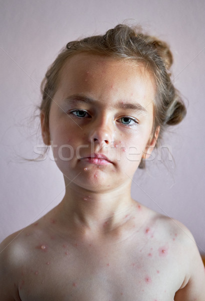 Portrait of a lovely 6 years old little girl with chickenpox  Stock photo © amok
