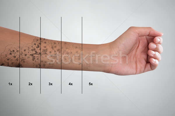 Tattoo Removal On Woman's Hand Stock photo © AndreyPopov