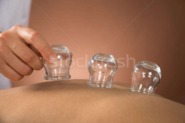 Person Giving Cupping Treatment Stock photo © AndreyPopov