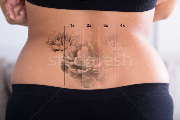 Tatuagem remoção quadril laser mão Foto stock © AndreyPopov