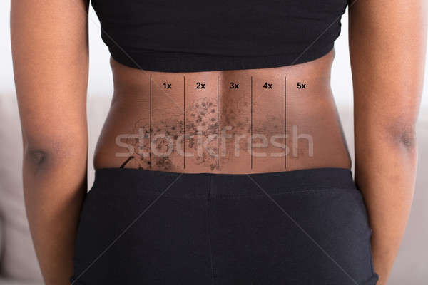 Laser Tattoo Removal On Woman's Hip Stock photo © AndreyPopov