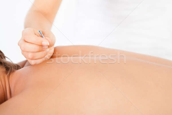 Man acupunctuur behandeling shirtless medische Stockfoto © AndreyPopov