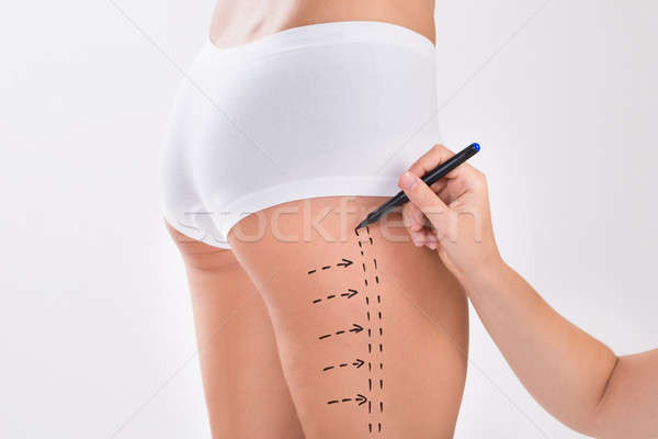 Stockfoto: Chirurg · vrouw · liposuctie · chirurgie · dij · afbeelding