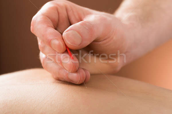 Stockfoto: Jonge · persoon · acupunctuur · behandeling