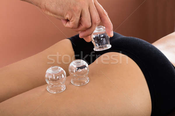 Stock photo: Close-up Of A Therapist Using Cup For Cupping Therapy