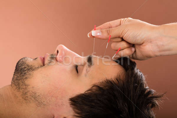 [[stock_photo]]: Homme · acupuncture · traitement · salon · de · beauté · main