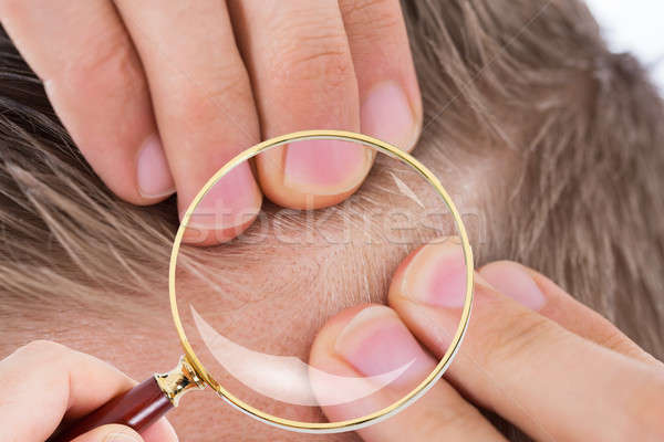 Dermatolog păr lupa mână medic Imagine de stoc © AndreyPopov