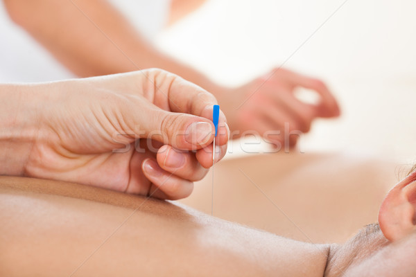 Foto stock: Mulher · acupuntura · tratamento · imagem · homem