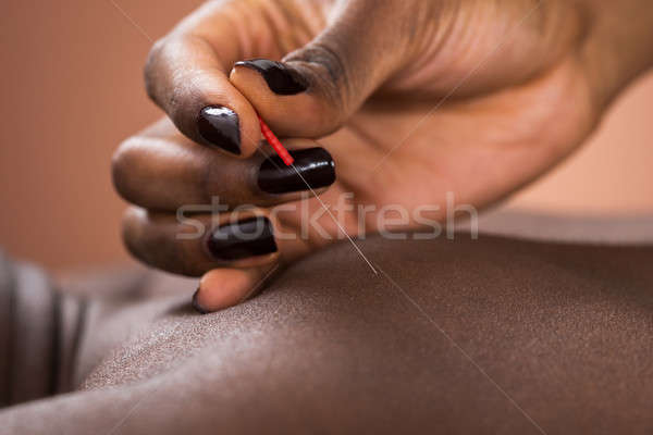 Terapeuta acupuntura tratamiento hombre primer plano spa Foto stock © AndreyPopov