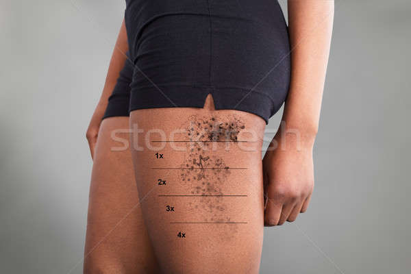 Foto stock: Laser · tatuagem · remoção · coxa · ver · mulher