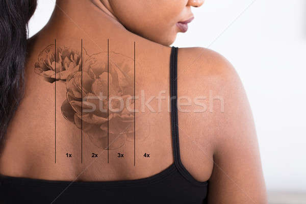 Imagine de stoc: Cu · laser · tatuaj · indepartare · înapoi · femeie