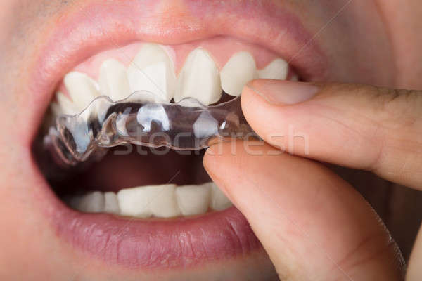 Man Adjusting Transparent Aligners In Teeth Stock photo © AndreyPopov