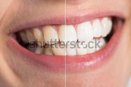 Person Teeth Before And After Whitening Stock photo © AndreyPopov