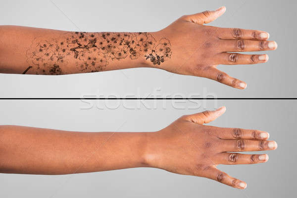 [[stock_photo]]: Laser · tatouage · enlèvement · main · gris · mode