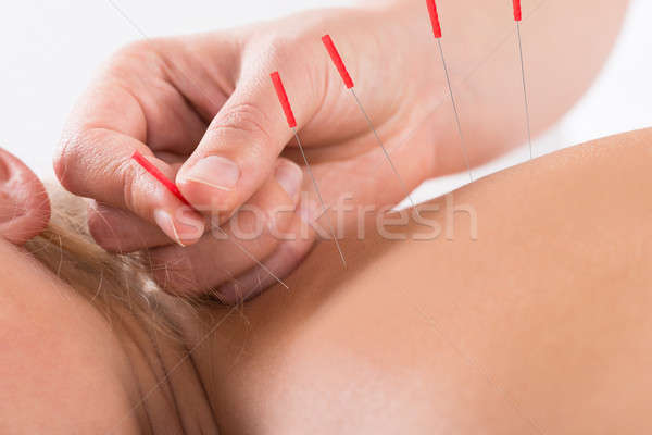 Hand Performing Acupuncture Therapy On Customer's Back Stock photo © AndreyPopov