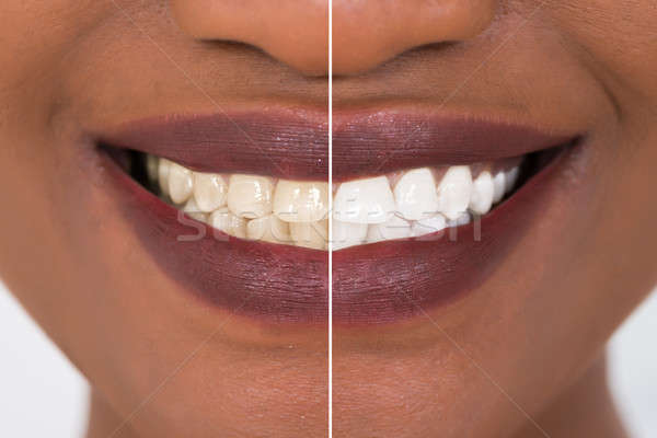 Woman Teeth Before And After Whitening Stock photo © AndreyPopov