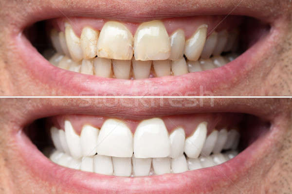 Om dinţi albire zâmbitor fericit Imagine de stoc © AndreyPopov