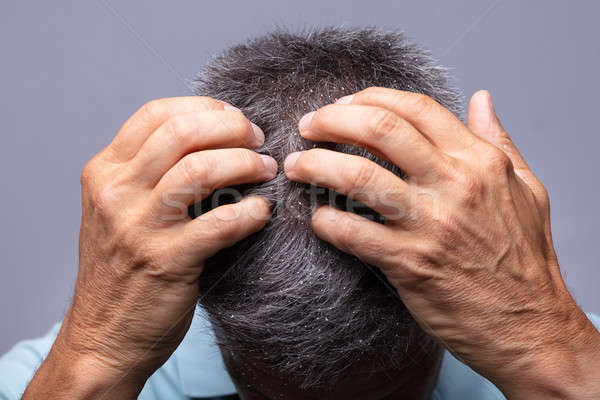 Włosy dojrzały mężczyzna człowiek medycznych skóry stres Zdjęcia stock © AndreyPopov