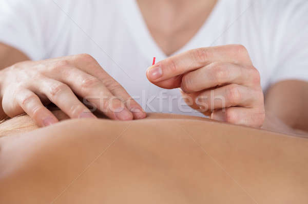 Személy akupunktúra kezelés közelkép fürdő kéz Stock fotó © AndreyPopov