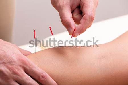 Terapeuta agopuntura ago indietro primo piano mani Foto d'archivio © AndreyPopov