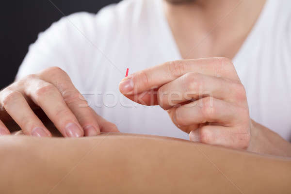 Stock photo: Person Getting An Acupuncture Treatment
