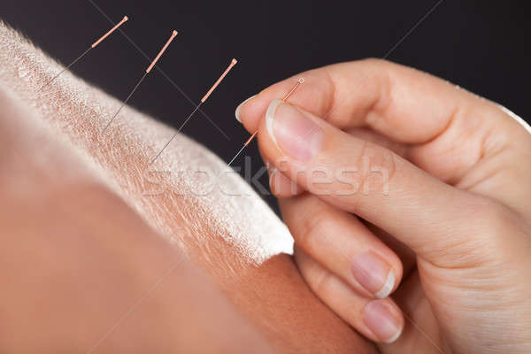 Stockfoto: Man · acupunctuur · behandeling · hand · naald