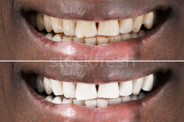 Om dinţi albire detaliu zâmbitor Imagine de stoc © AndreyPopov