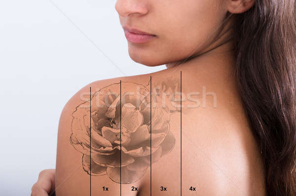 Сток-фото: татуировка · удаление · плечо · лазерного · белый · женщину