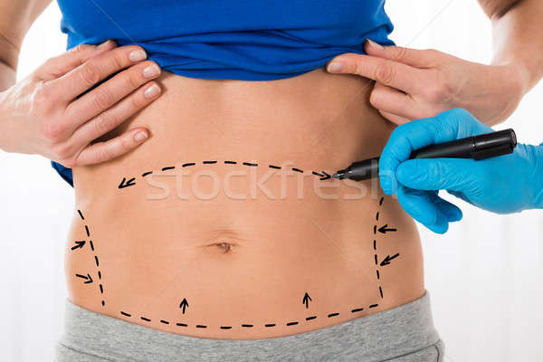 Cirujano manos dibujo corrección líneas estómago Foto stock © AndreyPopov