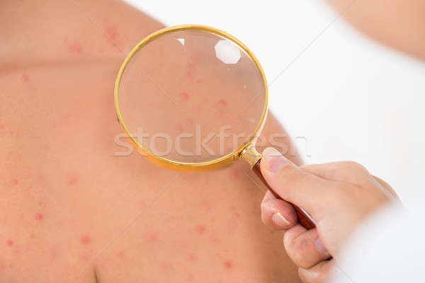 Médecin peau acné Homme patient [[stock_photo]] © AndreyPopov