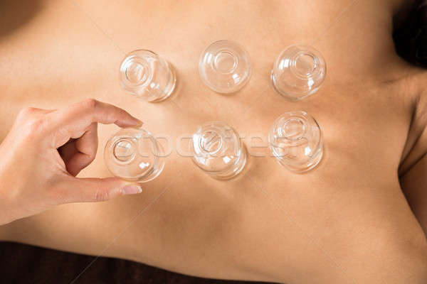Therapist Placing Cups On Back Stock photo © AndreyPopov
