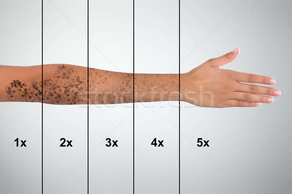 Tattoo Removal On Woman's Hand Stock photo © AndreyPopov
