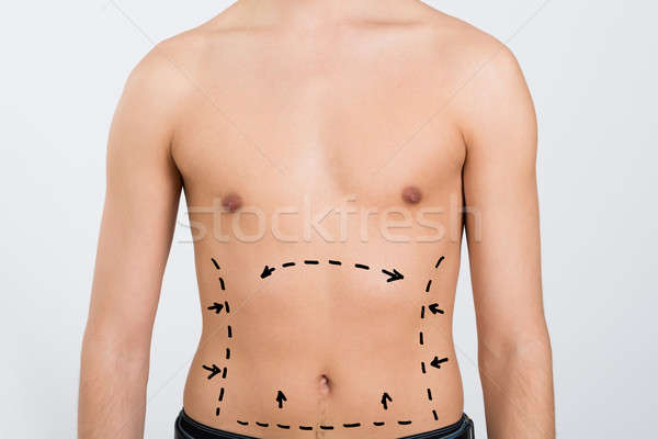 Abdomen corrección líneas primer plano abdominal cirugía Foto stock © AndreyPopov