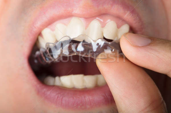 Stock photo: Man Adjusting Transparent Aligners In Teeth