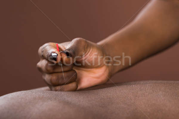 Hombre acupuntura tratamiento jóvenes África spa Foto stock © AndreyPopov