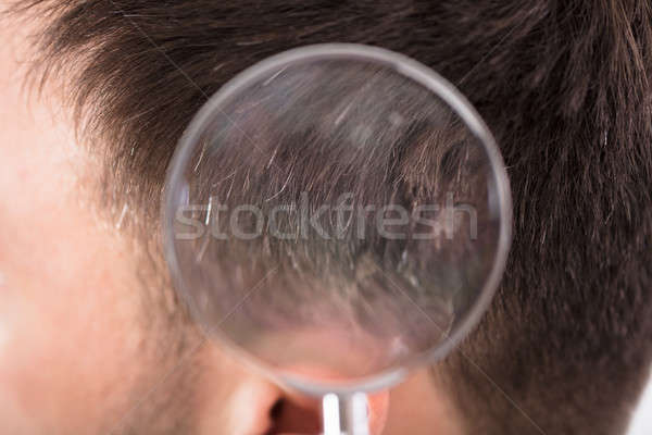 Dermatologue patient regarder cheveux loupe Photo stock © AndreyPopov