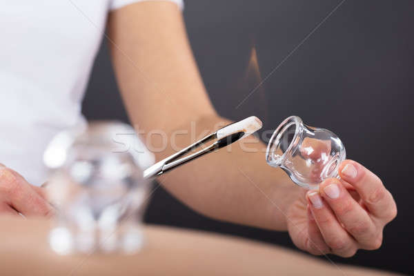 Therapist Giving Cupping Treatment Stock photo © AndreyPopov