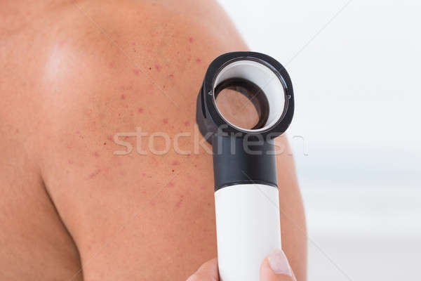 醫生 粉刺 皮膚 男子 人 商業照片 © AndreyPopov