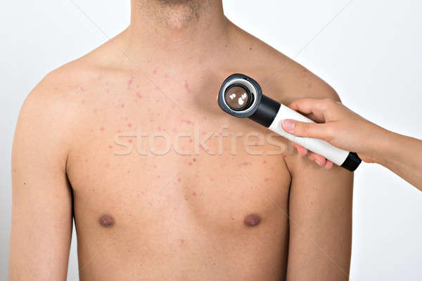 Persoon onderzoeken acne huid handen Stockfoto © AndreyPopov