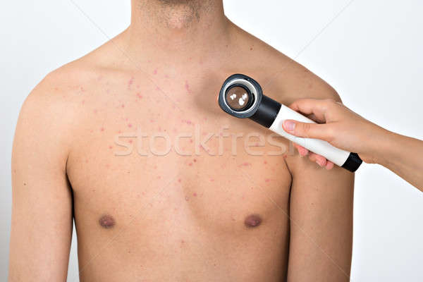 Person Examining Acne Skin With Dermatoscope Stock photo © AndreyPopov
