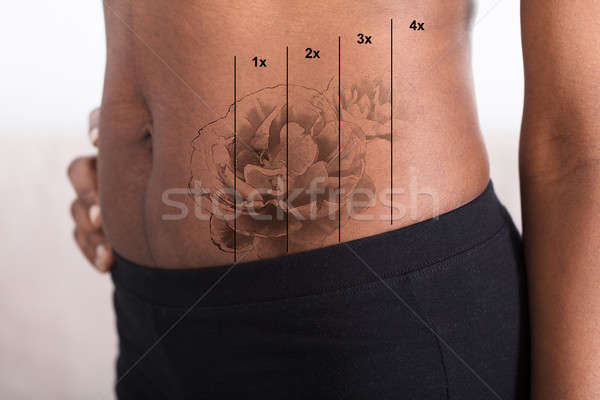 Cu laser tatuaj indepartare stomac femeie Imagine de stoc © AndreyPopov