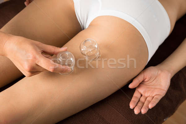 Therapist Placing Cups On Thigh Stock photo © AndreyPopov