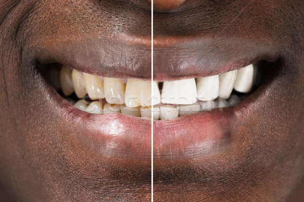 Man Teeth Before And After Whitening Stock photo © AndreyPopov