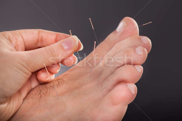 Hombre acupuntura tratamiento primer plano pies mano Foto stock © AndreyPopov