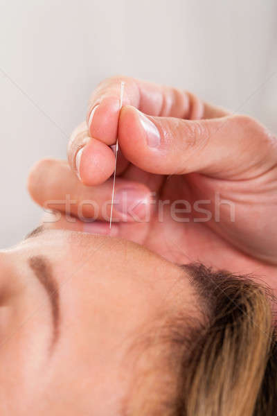 Vrouw acupunctuur behandeling lijn naalden huid Stockfoto © AndreyPopov